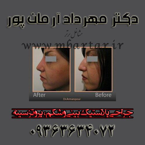 جراحی پلاستیک بینی و شکم ، پروتز سینه