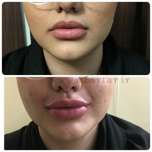 تزریق ژل و بوتاکس