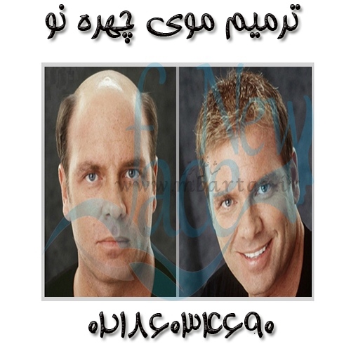 ترمیم موی چهره نو